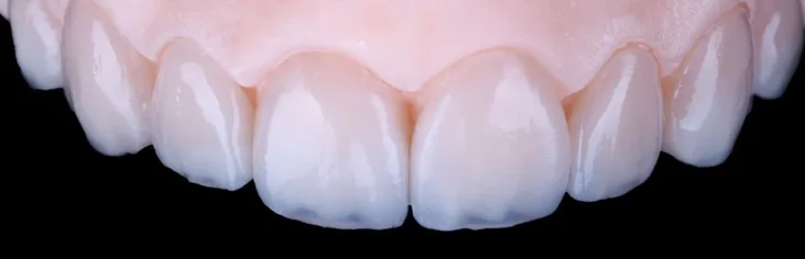 Carillas de cerámica de mínima invasión — detalle de un caso real
